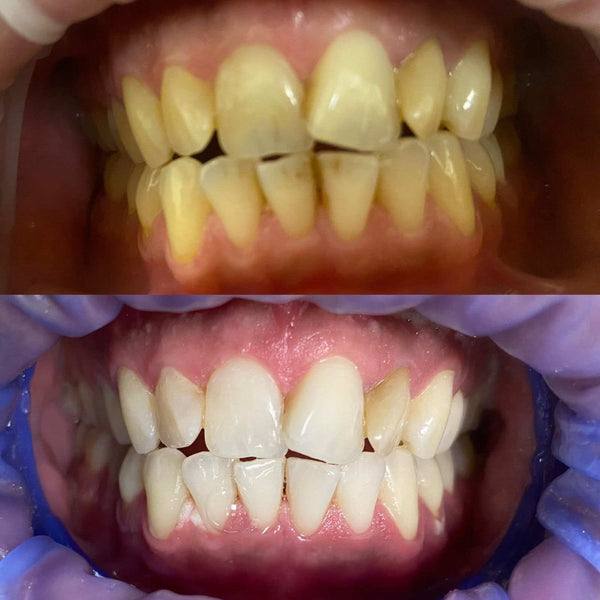 Teeth whitening kit ( best results)